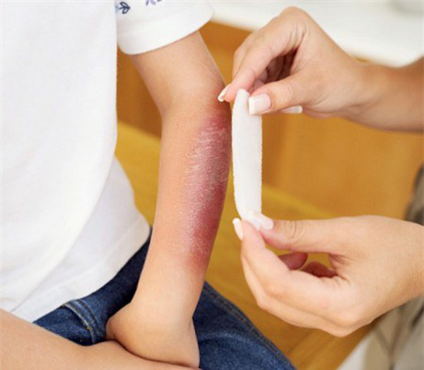 Cách Sơ Cứu Đúng Khi Gặp Vết Bỏng